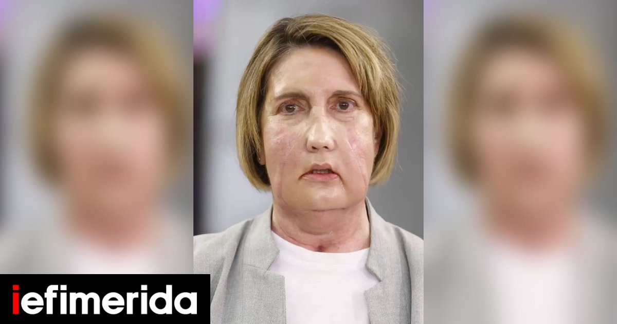 Γιατροί στην Ισπανία έγραψαν ιστορία: Η πρώτη μεταμόσχευση προσώπου με δότρια που υποβλήθηκε σε υποβοηθούμενη ευθανασία